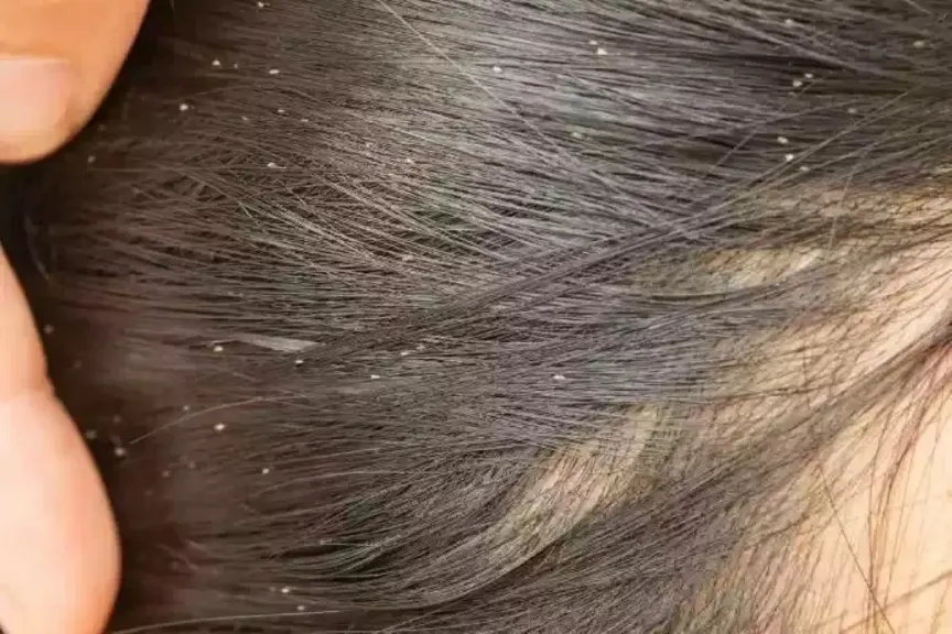 تفسير حلم القمل للمتزوجة